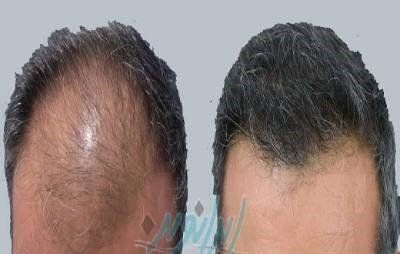 و کاشت موهای طلایی وی نکاتی در سال 2020 است