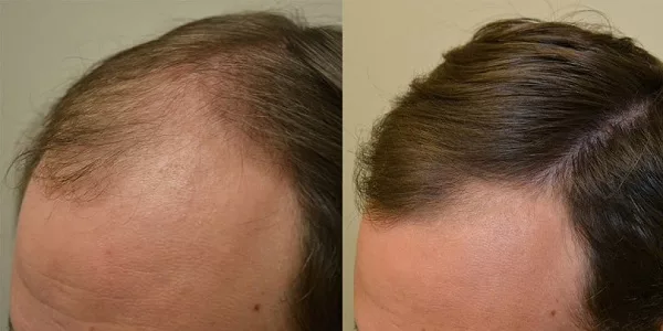 Treatment of hair loss in men with finasteride tablets